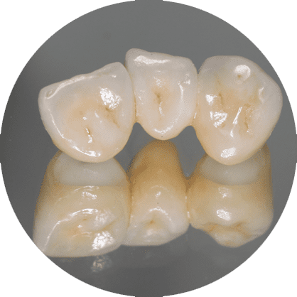 Zirconia bridge teeth on a table