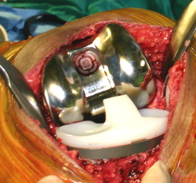 Closeup of a knee replacement being set inside a patient's leg