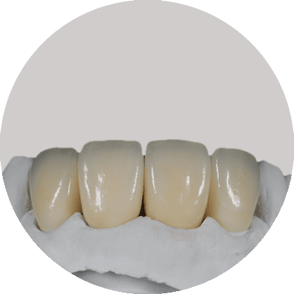 Lower jaw phonares hybrid arch dentures view of the back of the teeth