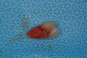 Extracted Tooth with External Resorption