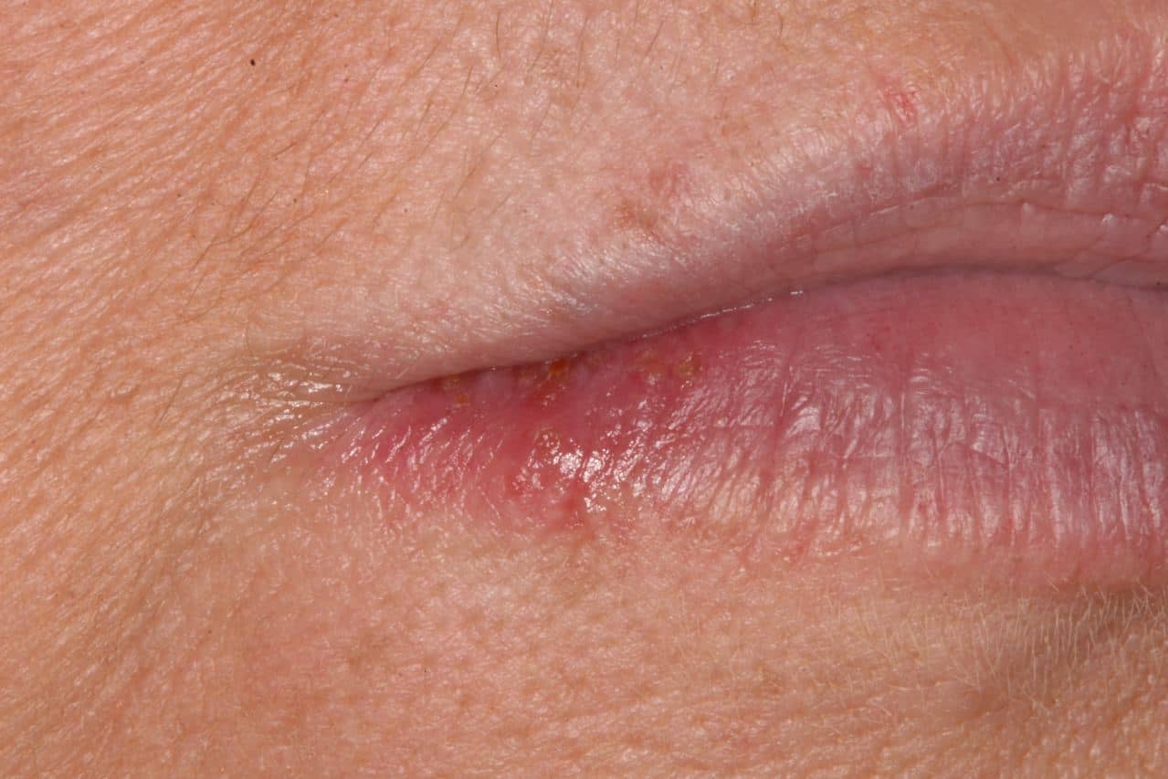Scaring, discoloration, and small bump spots on patient's bottom right lip