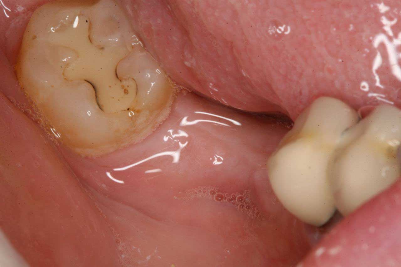 Closeup of lower gums where a tooth is missing