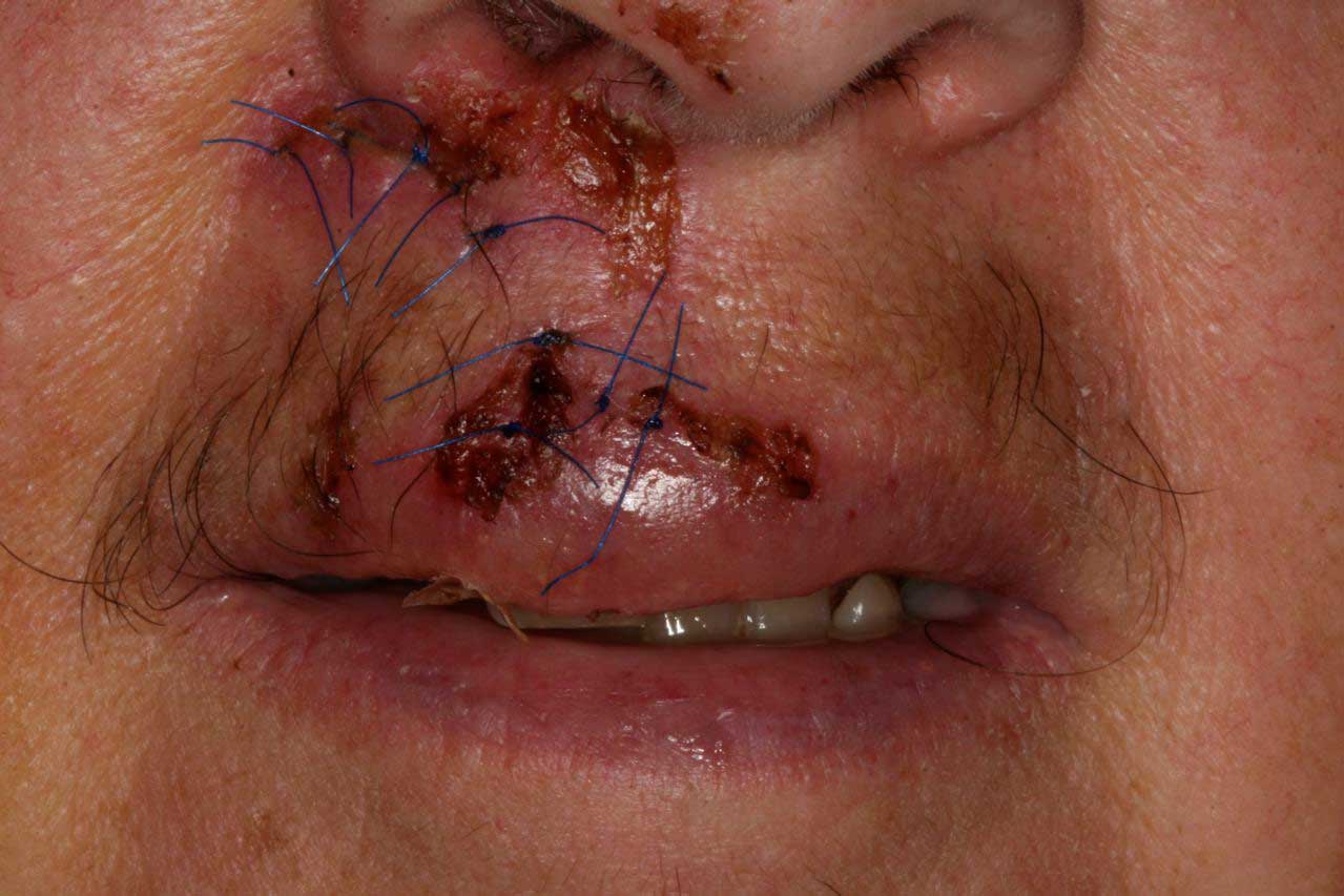 Patient's mouth with scars on their upper lip and nose