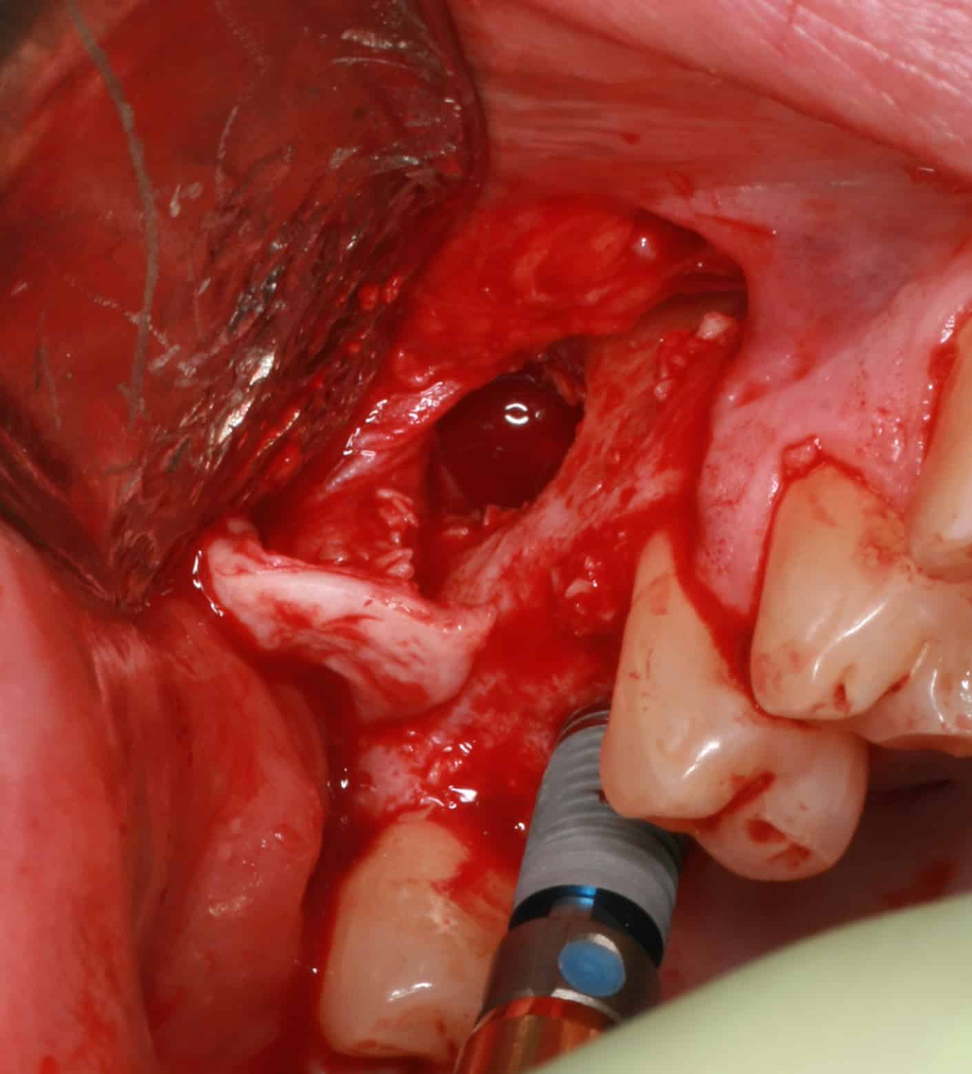 sinus lift with implant