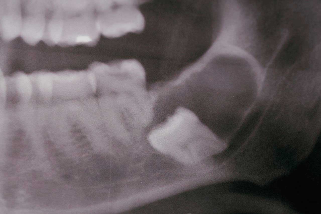 X-ray of a tooth inside bottom jaw beneath the gum line
