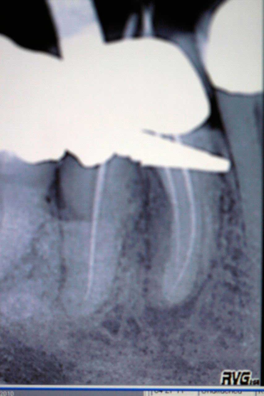 X-ray of a tooth with the root decaying