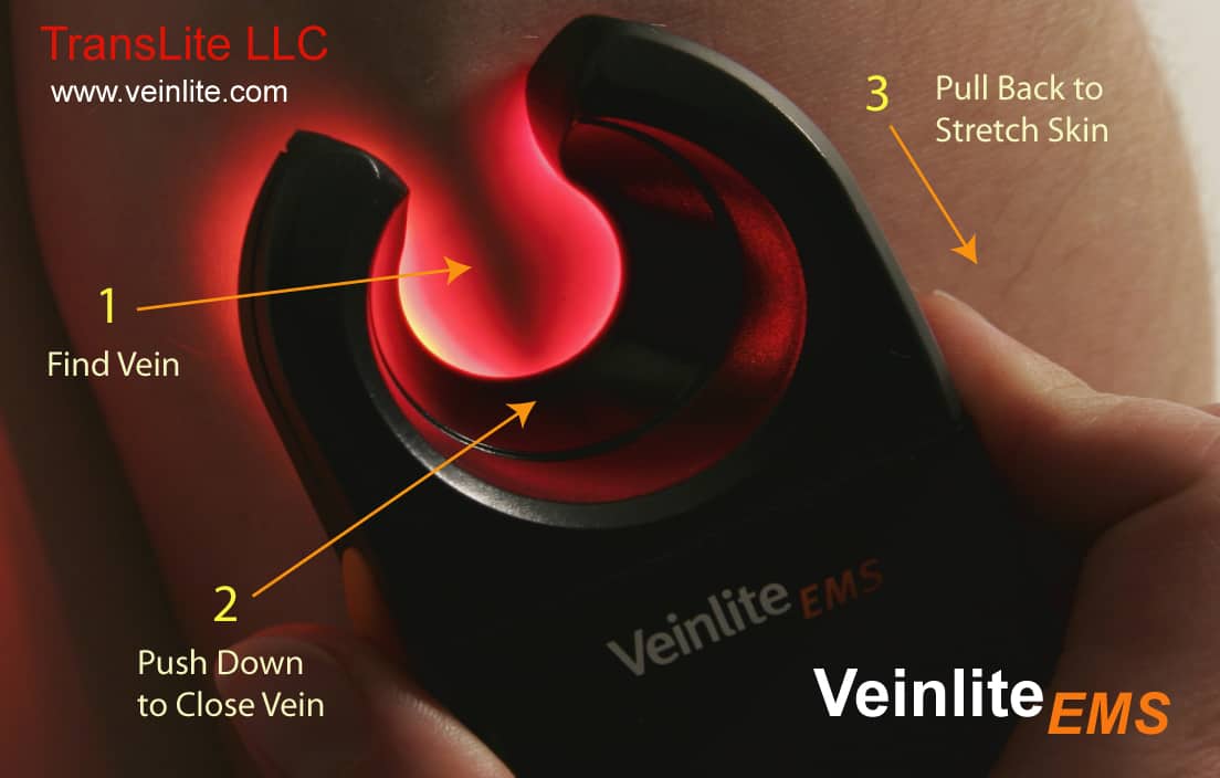 Graphic showing how a Veinlite EMS device finds the vein, you push down to close the vein, and you pull back closed device to stretch the skin