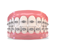 Model of top and bottom teeth with braces on