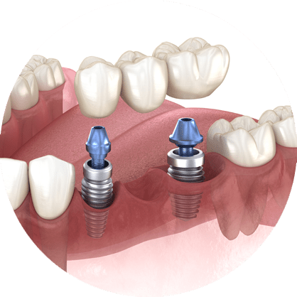 Animation showing the different pieces being applied on a bridge circled dental implant model