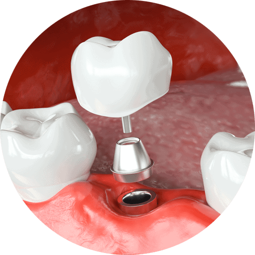 Animation showing the different pieces being applied on a dental implant model