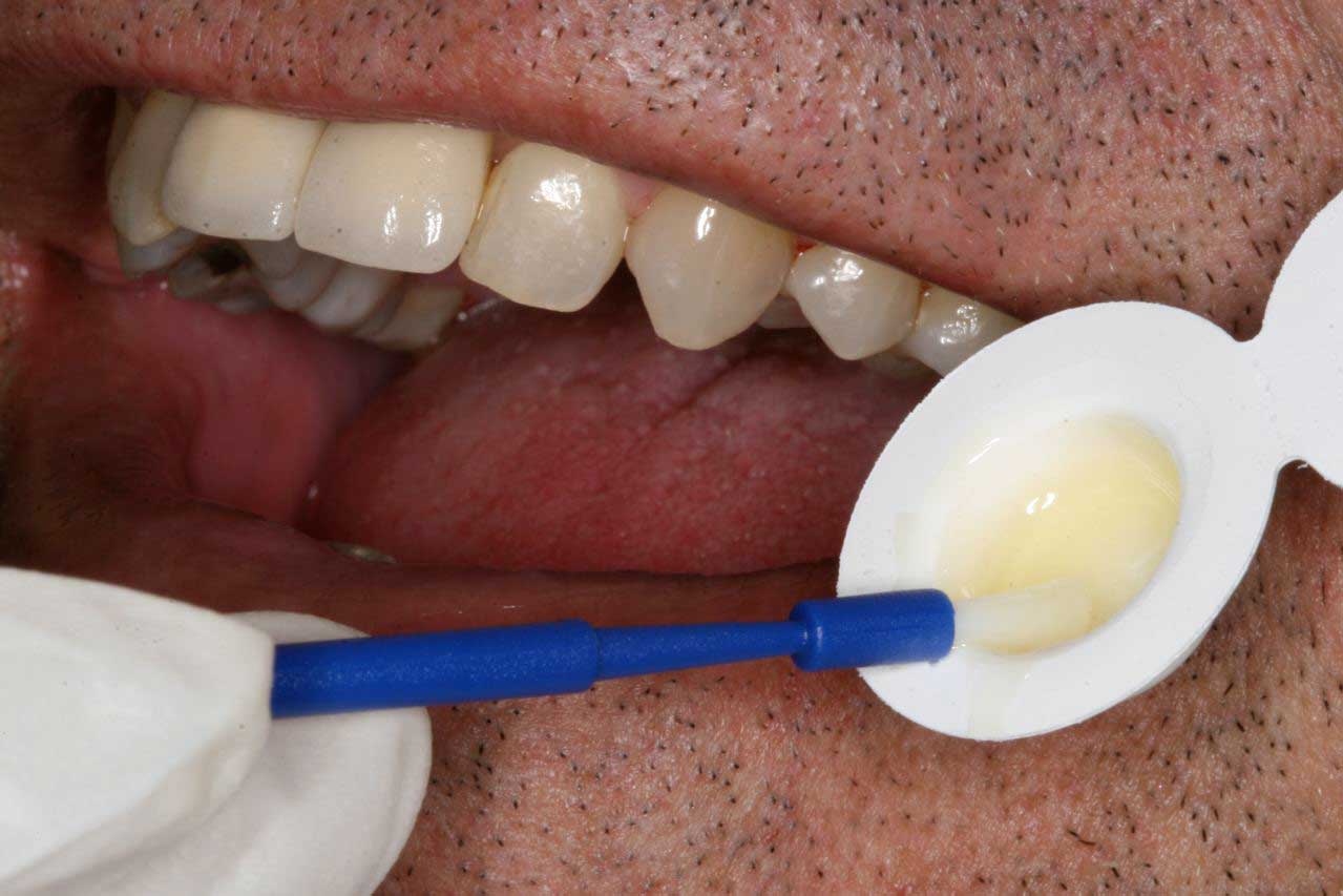 Patient receiving a fluoride treatment during an appointment at Cape Dental