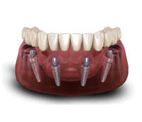 Animation of a front view of a full arch lower jaw implant denture with x-ray to show how the implant will be anchored into the jaw of a patient