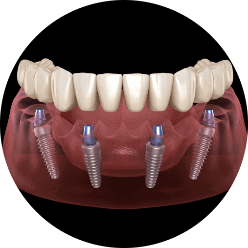 Front view lower jaw animated model showing the anchors being applied on a full arch dental implant