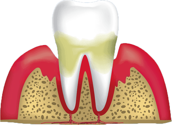 Periodontitis cartoon show yellowing on about half the tooth on the gumline of the tooth, along with redness damaged gums