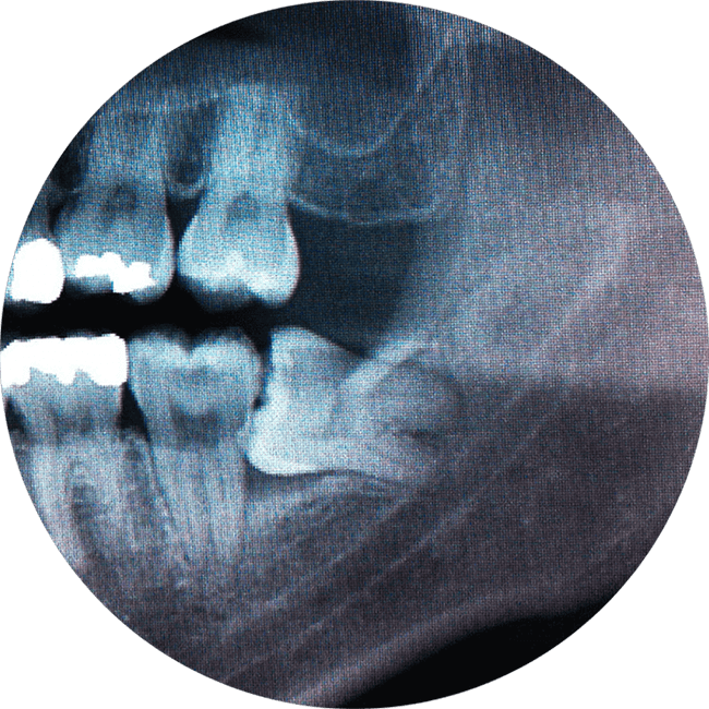 X-ray view of a wisdom tooth in need of extraction in a patient's mouth
