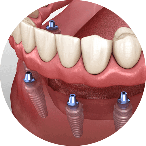 Animation showing the anchors being applied on an implant supported denture model