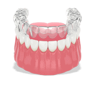 Animation of Invisalign braces being put on a model of lower teeth