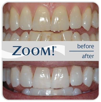 Before and after of patient's teeth show much whiter teeth after using Zoom!